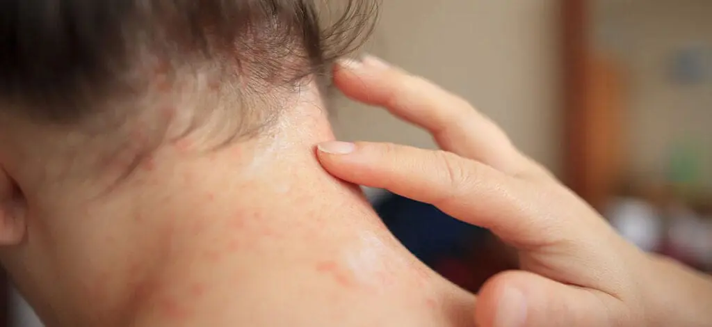 acupunctuur-psoriasis-acne
