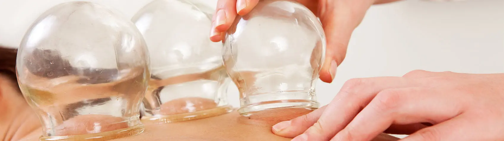 cupping acupunctuur rotterdam behandeling