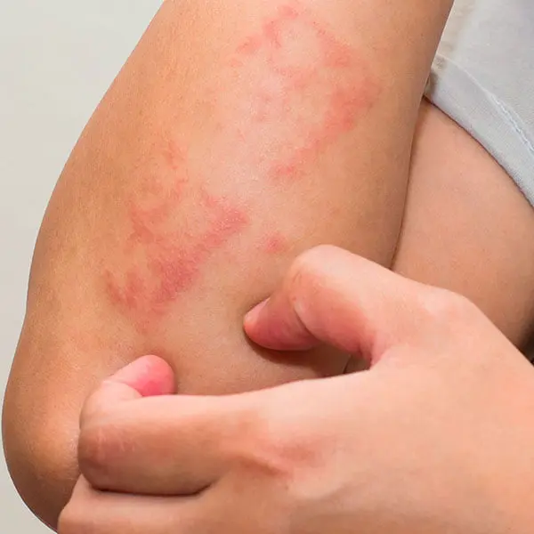 huidklachten-acupunctuur