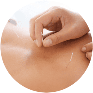 behandeling-acupunctuur-rotterdam