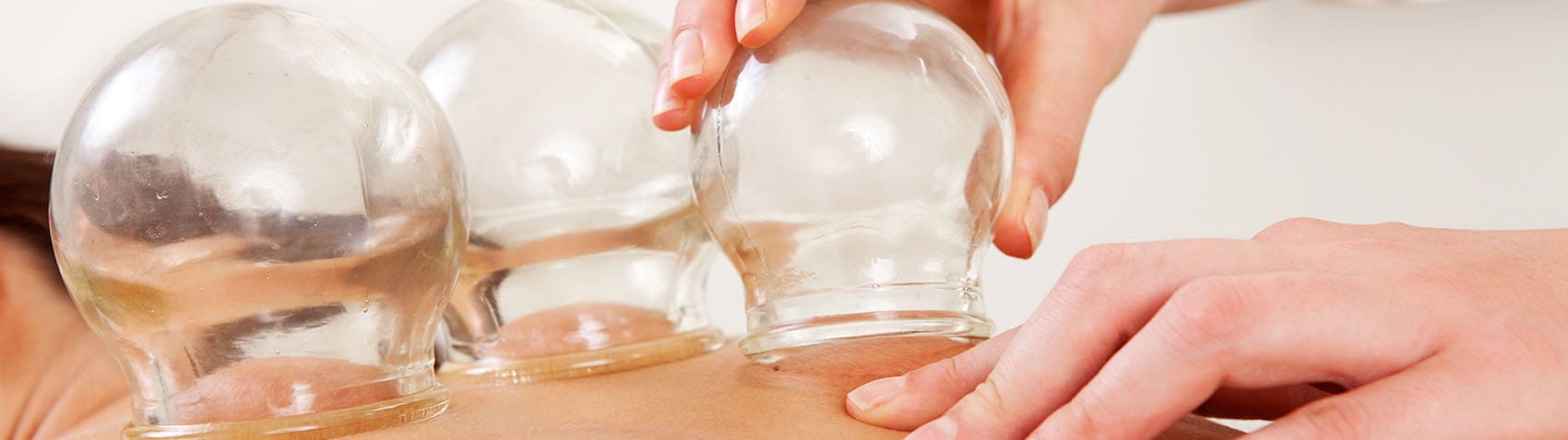 cupping acupunctuur rotterdam behandeling